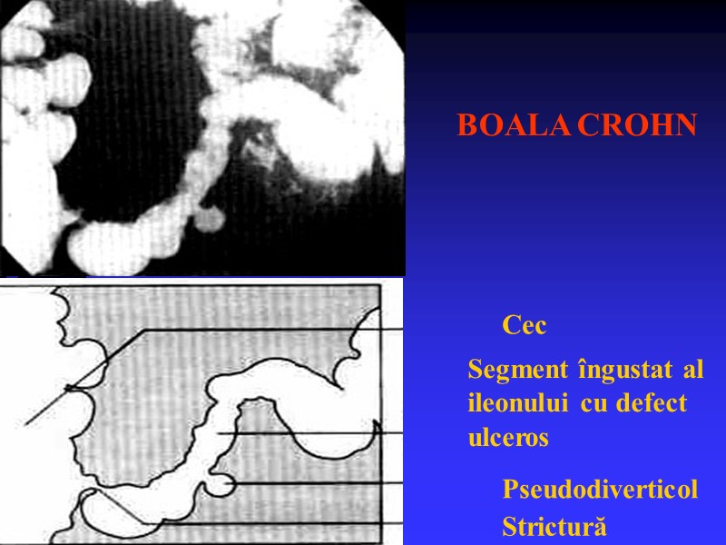 BOALA CROHN Cec Pseudodiverticol Strictură Segment îngustat al ileonului cu defect ulceros